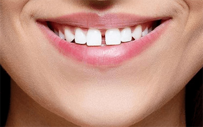 Diastema (Dişlerin Aralarındaki Boşluklar) Kapatma Tedavisi